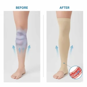 Diagram illustrating how open toe compression socks apply graduated pressure to reduce ankle and leg swelling (edema) effectively.